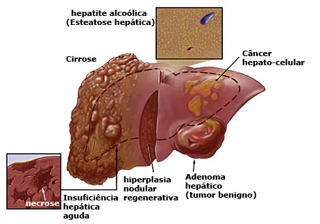 Hemangiomas No Fígado