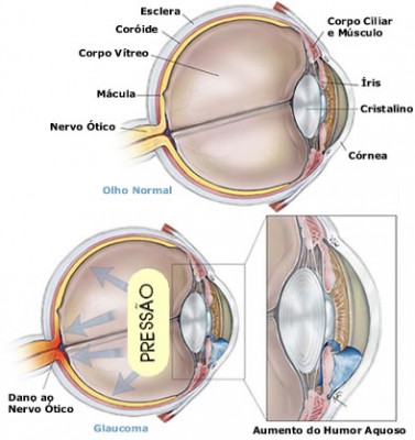 O Que é Glaucoma?