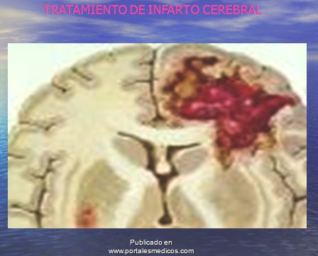 Infarto Cerebral: Características Gerais