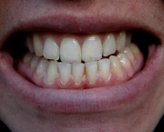 causas-da-sensibilidade-nos-dentes-01