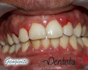 causas-da-sensibilidade-nos-dentes-03
