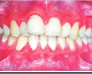 causas-da-sensibilidade-nos-dentes-04