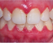causas-da-sensibilidade-nos-dentes-05