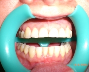 causas-da-sensibilidade-nos-dentes-06