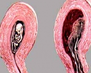 aborto-espontaneo-5