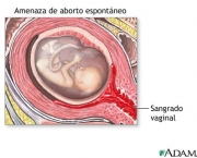 aborto-espontaneo-8