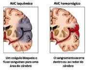 afasia-tem-cura-5