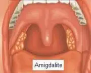 amigdalite-caseosa-4