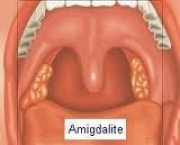 amigdalite-caseosa-4