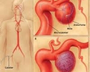aneurisma-cerebral-15