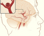 aneurisma-cerebral-7