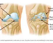 Artrose no Joelho (1)