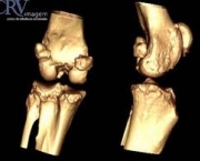 artrose-no-joelho-14