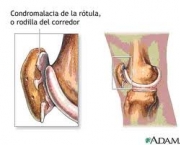 artrose-no-joelho-15