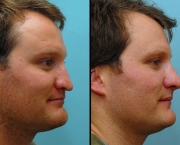 Causas de Erros nas Rinoplastias (1).jpeg