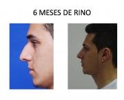 Causas de Erros nas Rinoplastias (1).jpg