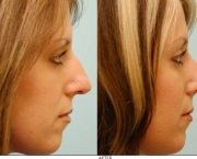 Causas de Erros nas Rinoplastias (2).jpeg