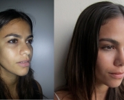 Causas de Erros nas Rinoplastias (2).jpg