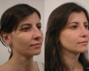 Causas de Erros nas Rinoplastias (3).jpg