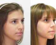 Causas de Erros nas Rinoplastias (4).jpg
