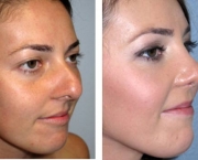 Causas de Erros nas Rinoplastias (5).jpg