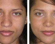 Causas de Erros nas Rinoplastias (6).jpg