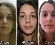 Causas de Erros nas Rinoplastias (10).jpg