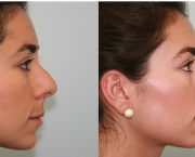 Causas de Erros nas Rinoplastias (8).jpg