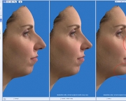 Causas de Erros nas Rinoplastias (9).jpg