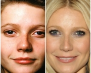 Causas de Erros nas Rinoplastias (11).jpg