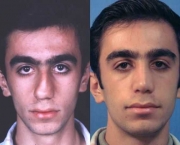 Causas de Erros nas Rinoplastias (12).jpg