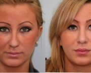 Causas de Erros nas Rinoplastias (15).jpg