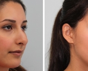 Causas de Erros nas Rinoplastias (16).jpg