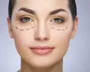 Blefaroplastia (1)