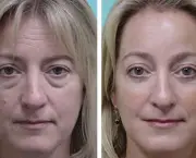 Blefaroplastia (1)