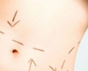 Cicatriz de Abdominoplastia (1)