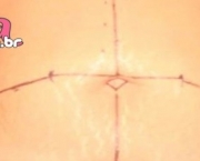 Cicatriz de Abdominoplastia (3)