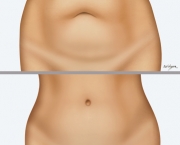 Cicatriz de Abdominoplastia (6)