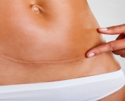 Cicatriz de Abdominoplastia (9)