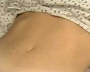 Cicatriz de Abdominoplastia (12)