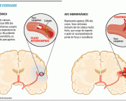 como-acontece-um-avc-4