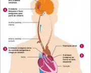 como-acontece-um-avc-3