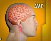 como-acontece-um-avc-6