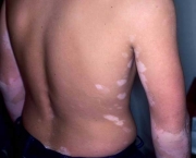 como-e-classificado-o-vitiligo-2