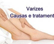 Como Evitar Varizes (3)