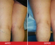 Como Evitar Varizes (16)