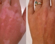 como-o-vitiligo-evolui-e-e-uma-doenca-comum-3