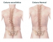 como-prevenir-a-escoliose-2