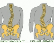 como-prevenir-a-escoliose-6