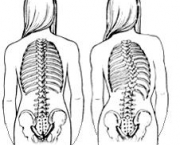 como-prevenir-a-escoliose-6